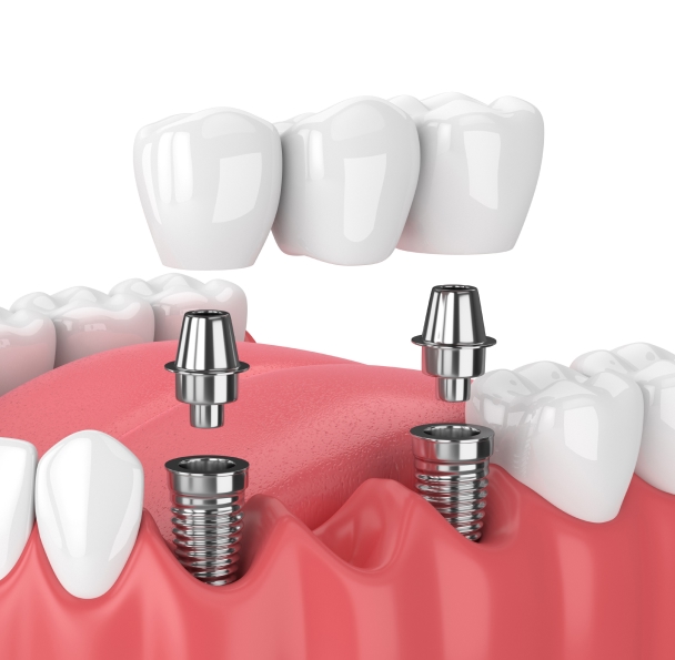 Implant-Supported Bridge-2